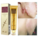 Crème anti - cicatrices, soins pour la peau, traitement des vergetures, boutons, taches - Hodamart