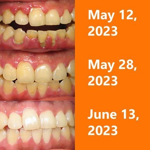 UNPREE™ - AMPOULES DE RÉPARATION GENCIVES - Hodamart
